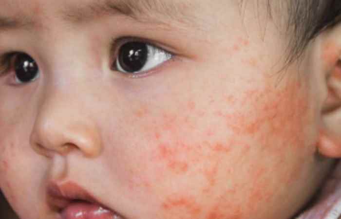 Nhịp cầu sức khỏe Viêm da ở trẻ sơ sinh những biểu hiện không được bỏ qua 01-11-2018