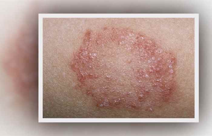 Nhịp cầu sức khỏe Bệnh lang ben 08-11-2018