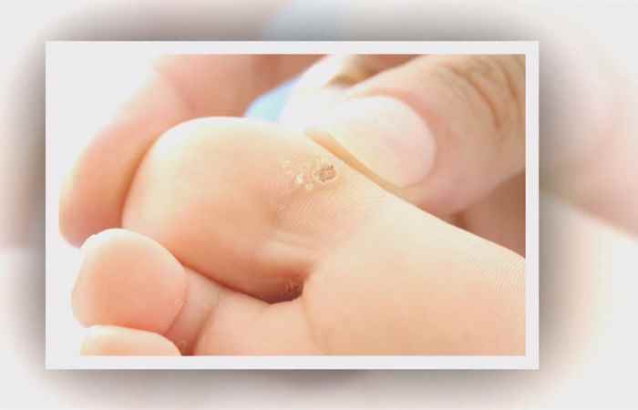 Nhịp cầu sức khỏe Cách điều trị mục cóc không lo tái phát 09-11-2018