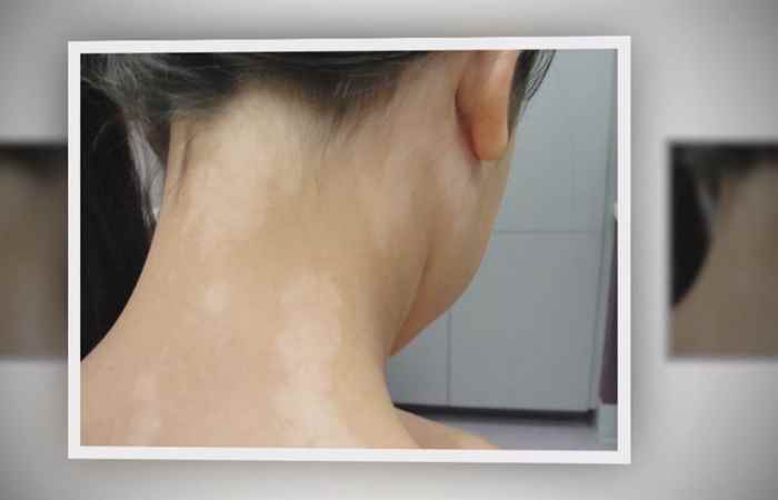 Nhịp cầu sức khỏe Bệnh lang ben 31-10-2018