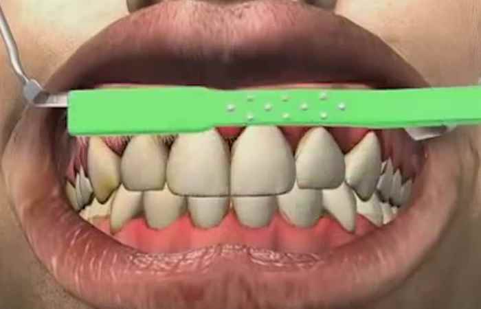 Nhịp cầu y tế - Điều trị viêm nướu răng ở trẻ em 12-06-2018