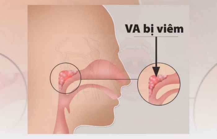 Sống khỏe 360 - Viêm VA gây ra hậu quả gì? (21-10-2019)