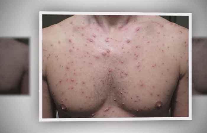 Sống khỏe 360 Trẻ bị thủy đậu cha mẹ xử trí thế nào? 26-03-2019