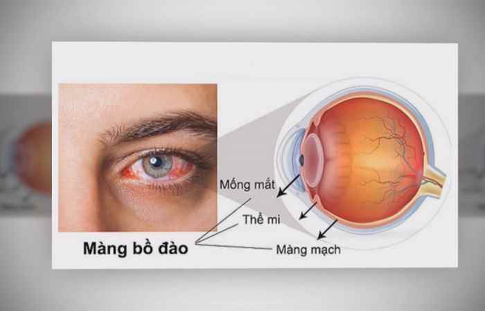 Sống khỏe 360 Viêm màng bồ đào 29-03-2019