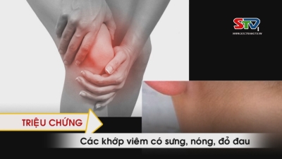 Nhịp cầu y tế - Bệnh Thấp khớp cấp 01-06-2016
